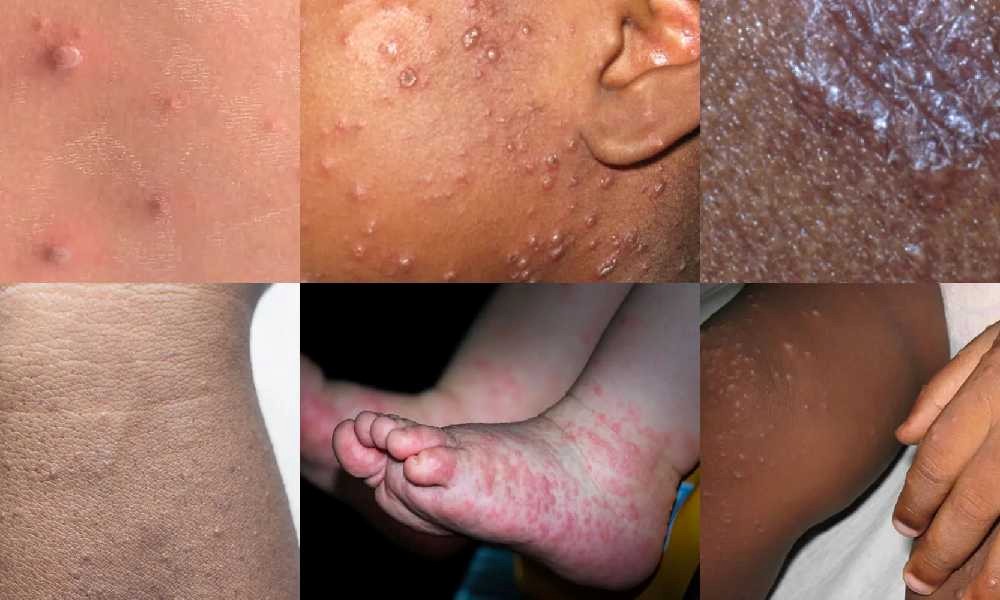 علل شایع انواع حساسیت های پوستی در کودکان